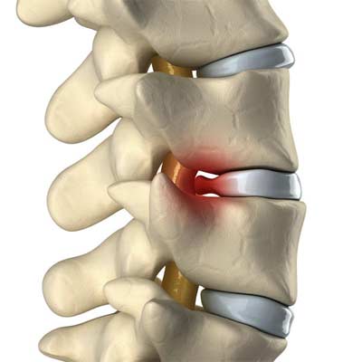 Hernia de disc