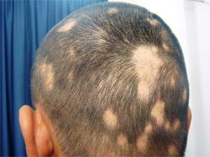 Alopecia areata - caderea parului