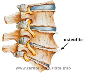 Osteofite