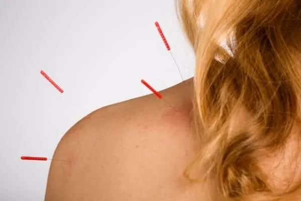 Acupunctura